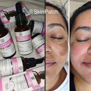 Tonico Despigmentante 🇨🇴 *Eliminador de manchas* Removes dark spots + ac…